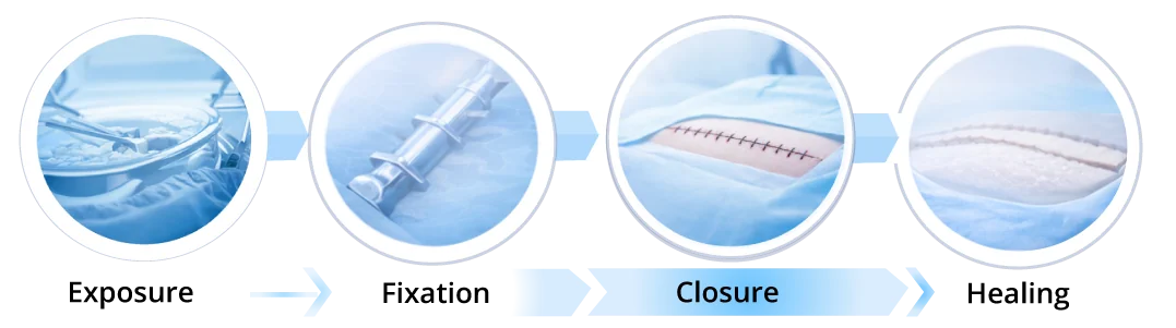 Surgical phases highlighting closure